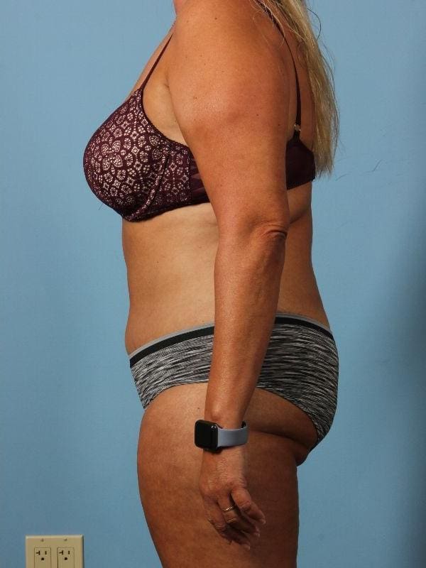 Abdominoplasty Patient Photo - Case 12146 - after view-1