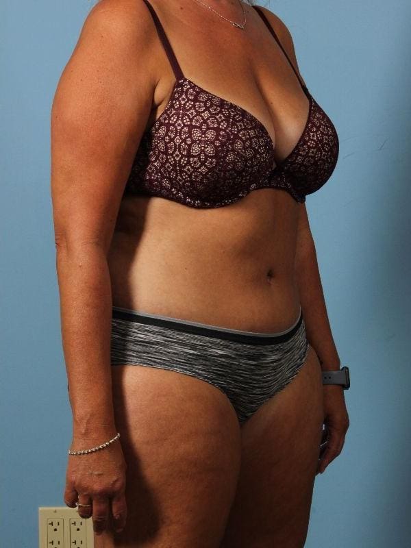 Abdominoplasty Patient Photo - Case 12146 - after view-4
