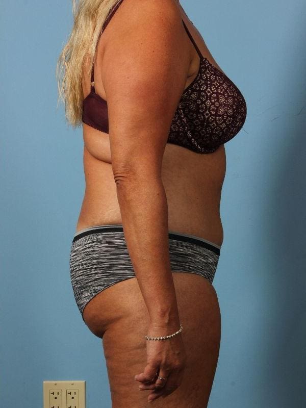 Abdominoplasty Patient Photo - Case 12146 - after view-2