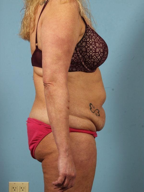 Abdominoplasty Patient Photo - Case 12146 - before view-2