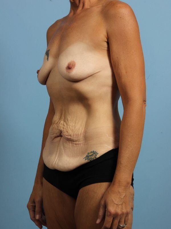 Abdominoplasty Patient Photo - Case 12158 - before view-3