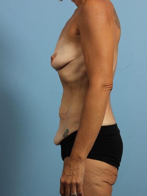 Abdominoplasty Patient Photo - Case 12158 - before view-1