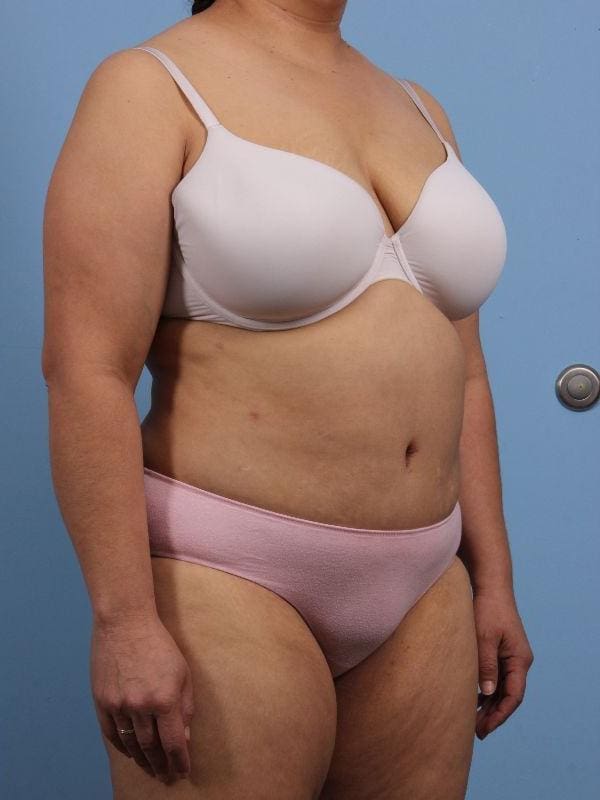 Abdominoplasty Patient Photo - Case 12194 - after view-4