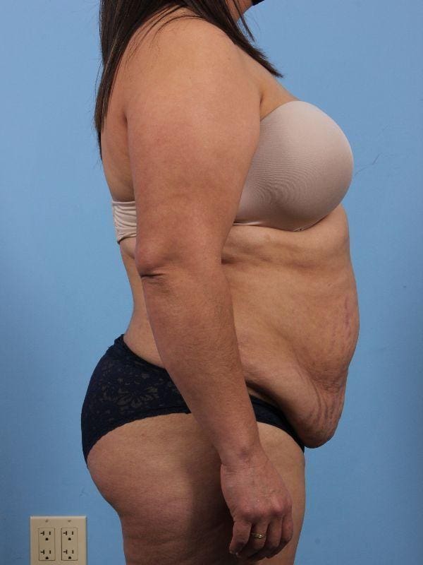 Abdominoplasty Patient Photo - Case 12194 - before view-2