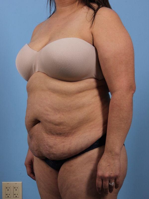 Abdominoplasty Patient Photo - Case 12194 - before view-3