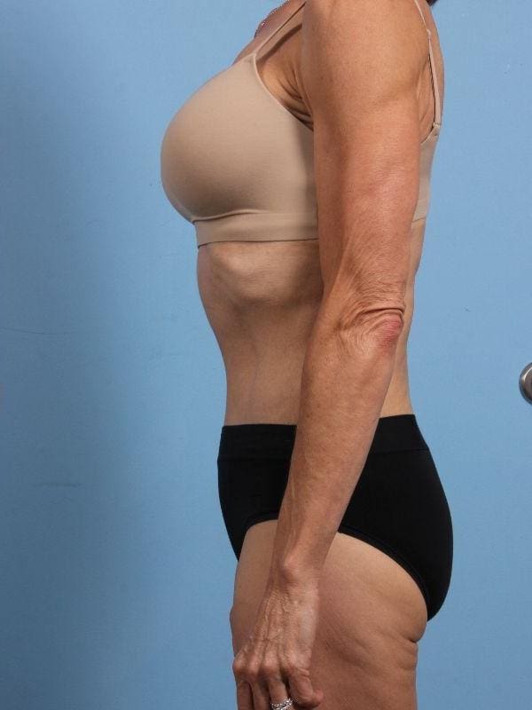 Abdominoplasty Patient Photo - Case 12206 - after view-1