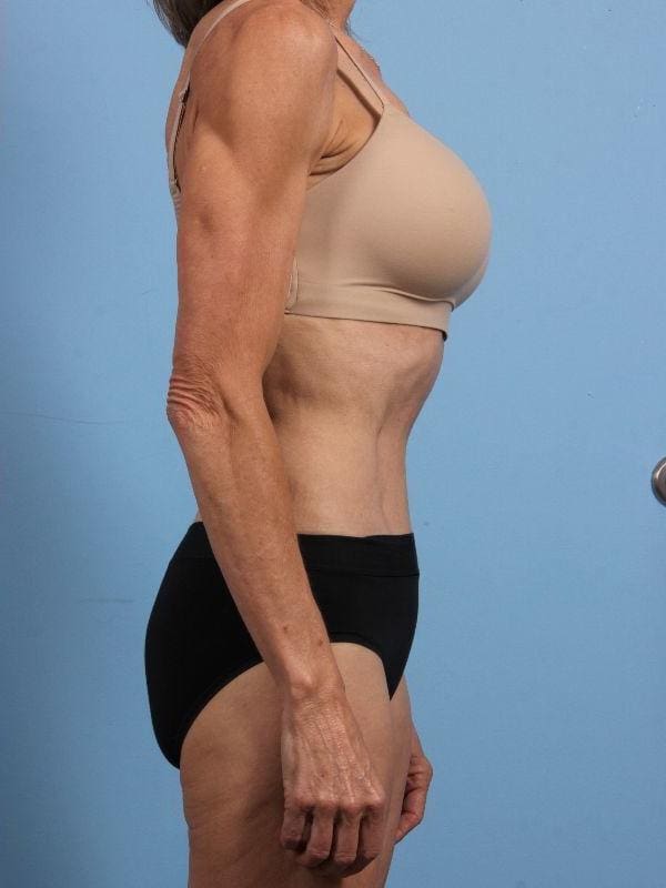 Abdominoplasty Patient Photo - Case 12206 - after view-2