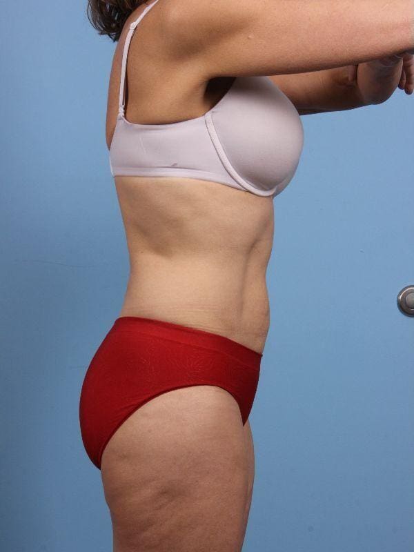 Abdominoplasty Patient Photo - Case 12206 - before view-2