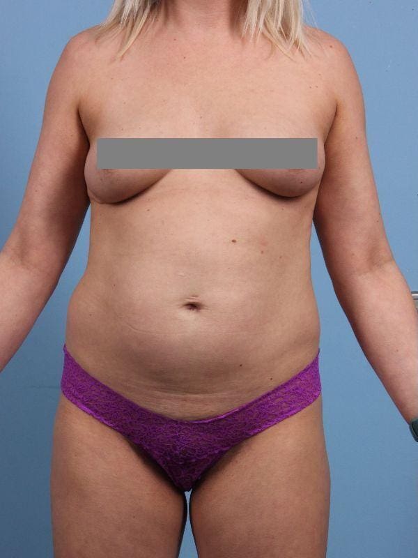 Abdominoplasty Patient Photo - Case 12231 - before view-