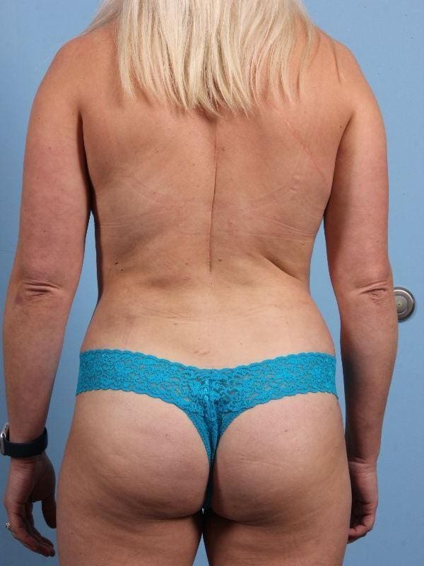 Abdominoplasty Patient Photo - Case 12231 - after view-3