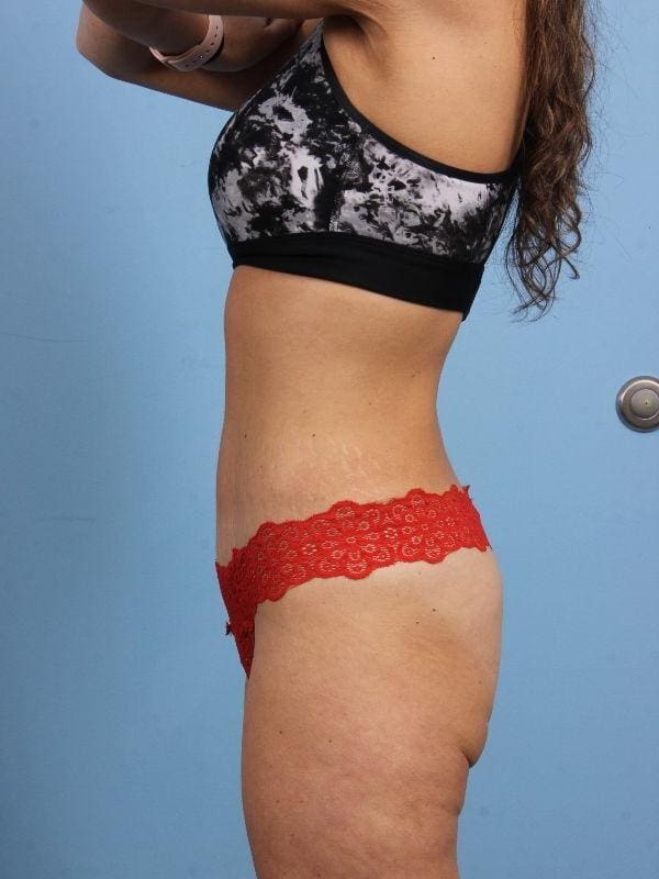 Abdominoplasty Patient Photo - Case 12263 - after view-1