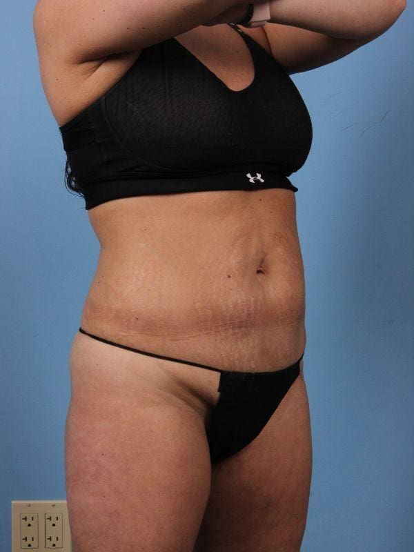 Abdominoplasty Patient Photo - Case 12263 - before view-4