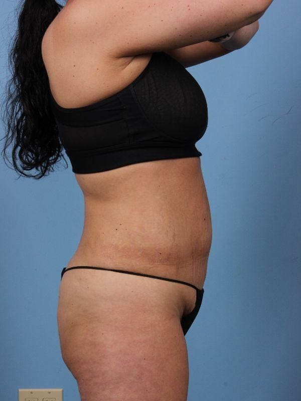 Abdominoplasty Patient Photo - Case 12263 - before view-2