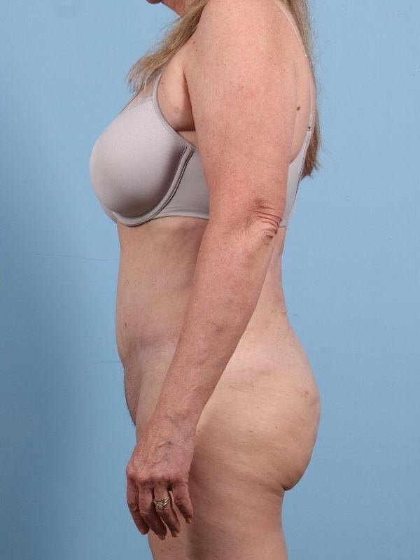 Abdominoplasty Patient Photo - Case 12276 - after view-1