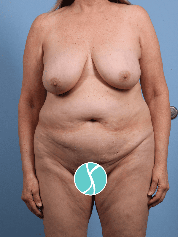 Abdominoplasty Patient Photo - Case 12276 - before view-