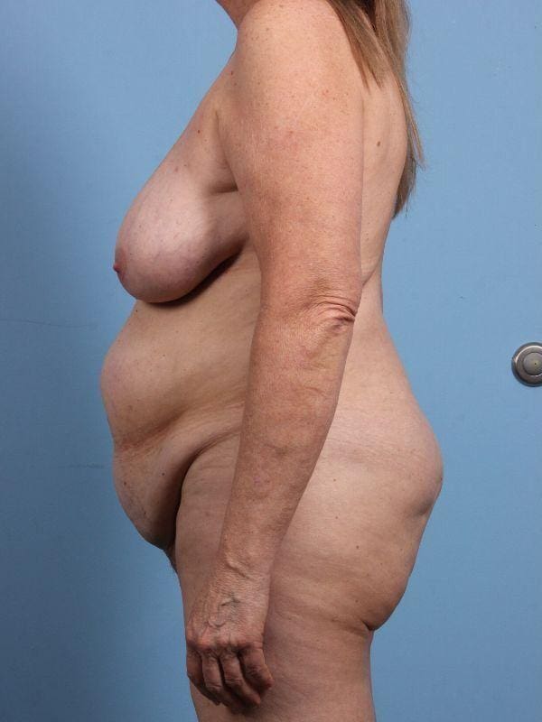 Abdominoplasty Patient Photo - Case 12276 - before view-1