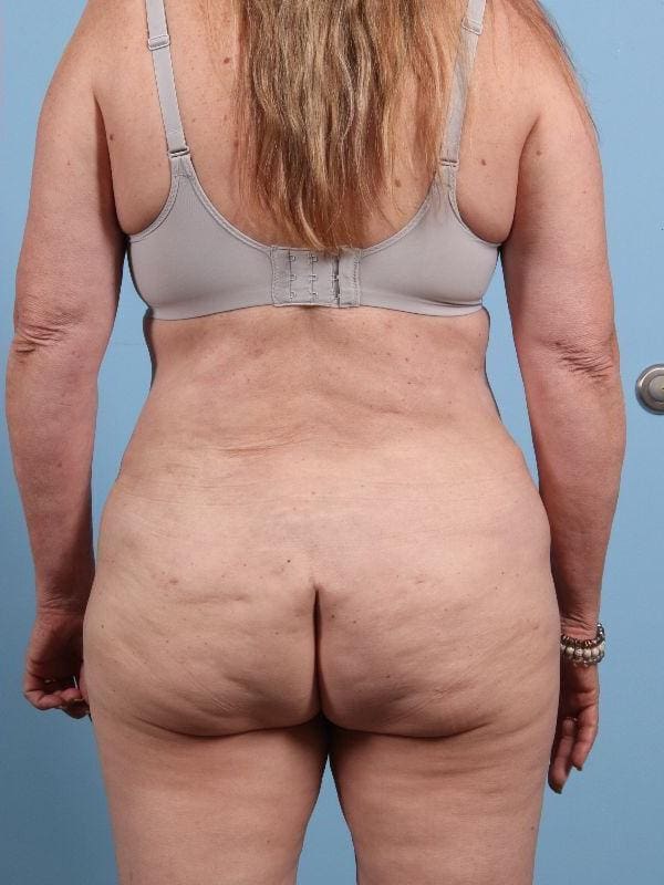 Abdominoplasty Patient Photo - Case 12276 - after view-5