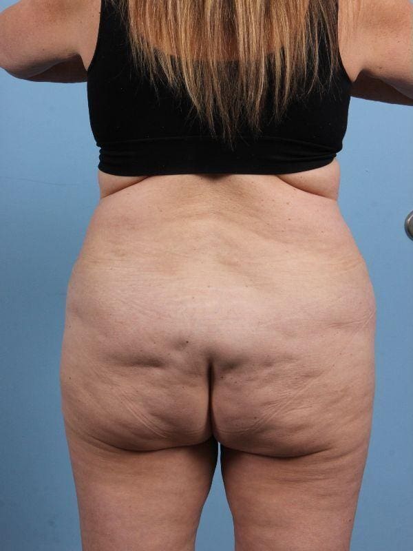 Abdominoplasty Patient Photo - Case 12276 - before view-5
