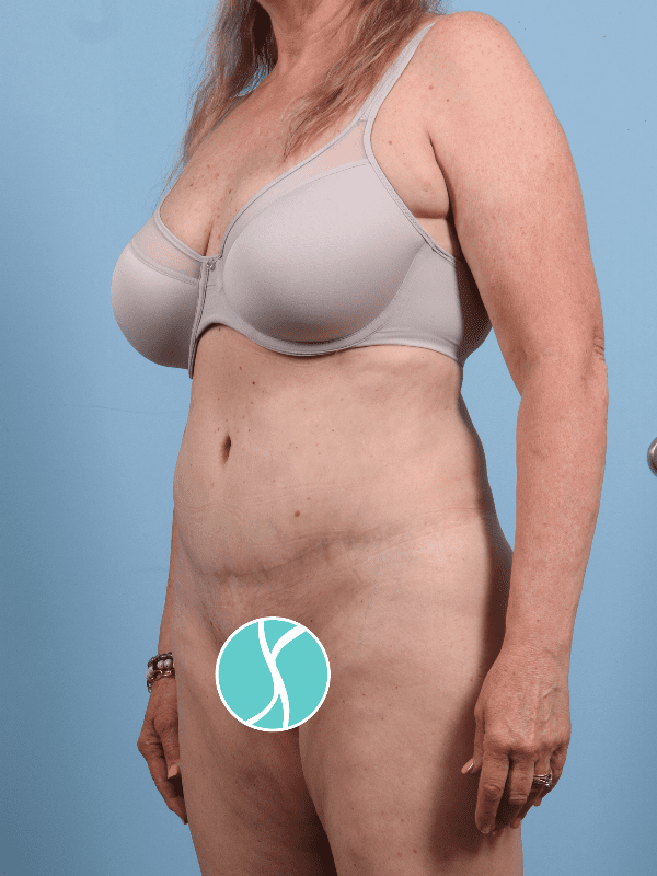 Abdominoplasty Patient Photo - Case 12276 - after view-3