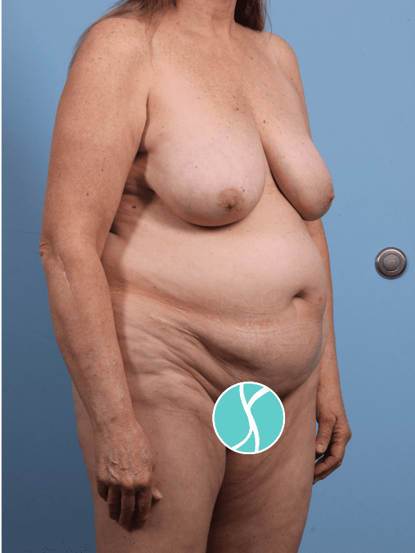 Abdominoplasty Patient Photo - Case 12276 - before view-4