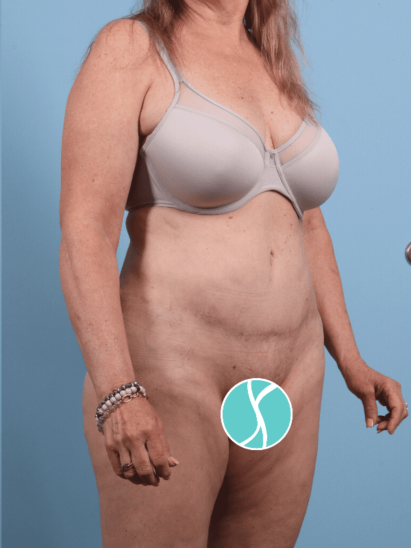 Abdominoplasty Patient Photo - Case 12276 - after view-4