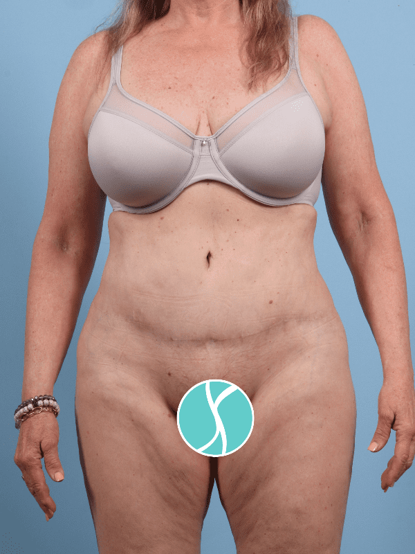 Abdominoplasty Patient Photo - Case 12276 - after view