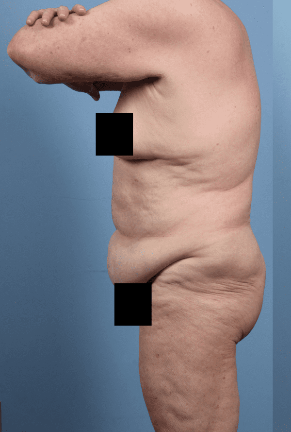 Abdominoplasty Patient Photo - Case 12312 - before view-1