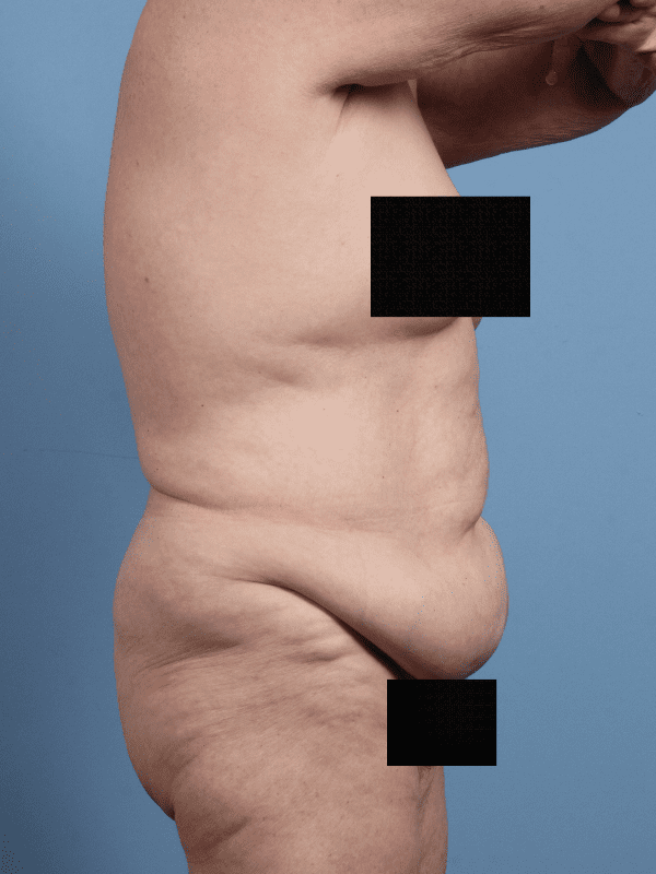 Abdominoplasty Patient Photo - Case 12312 - before view-2