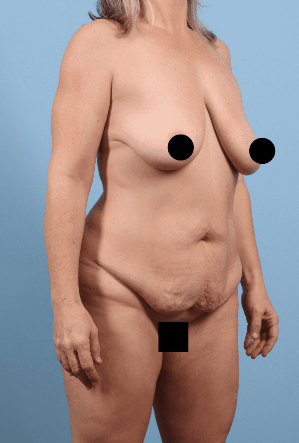 Abdominoplasty Patient Photo - Case 12324 - before view-4