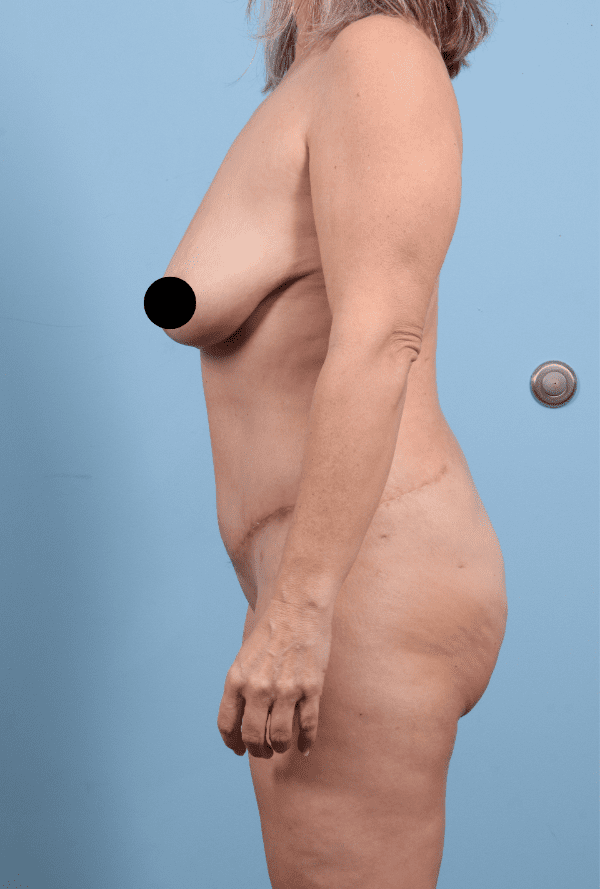 Abdominoplasty Patient Photo - Case 12324 - after view-1