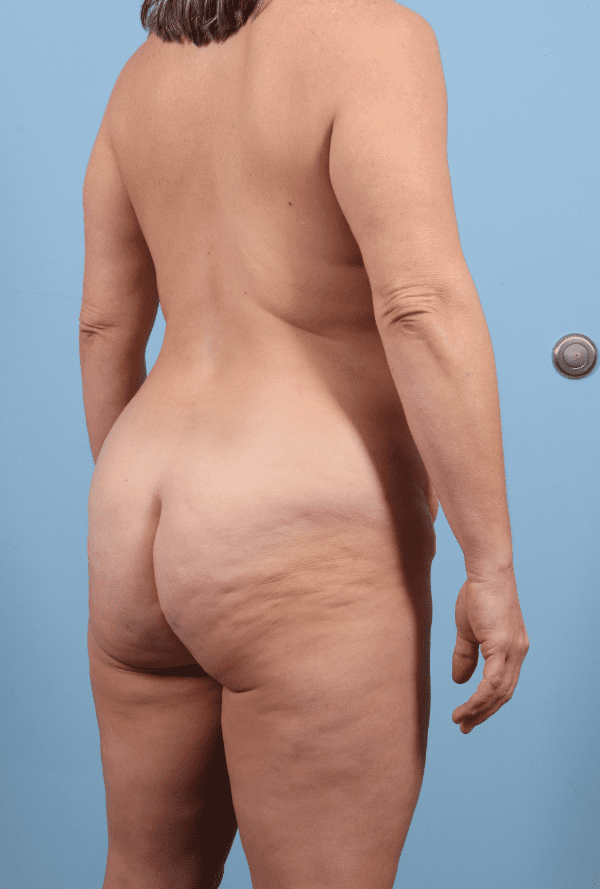 Abdominoplasty Patient Photo - Case 12324 - before view-7