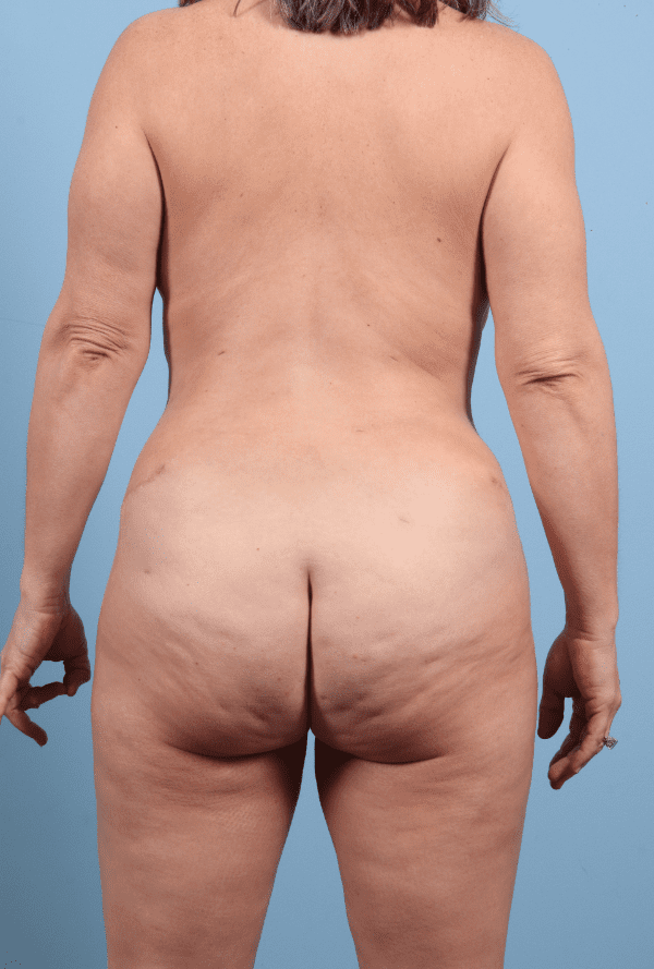 Abdominoplasty Patient Photo - Case 12324 - after view-6