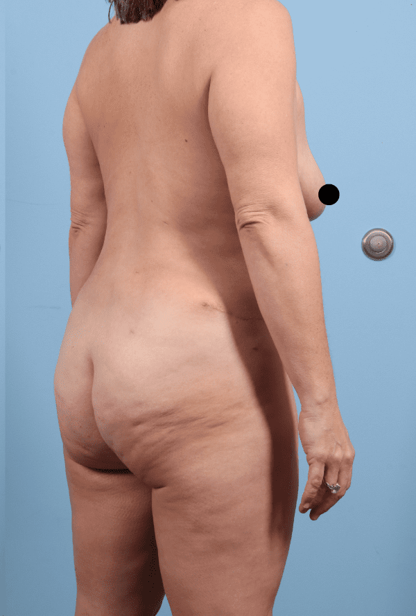 Abdominoplasty Patient Photo - Case 12324 - after view-7