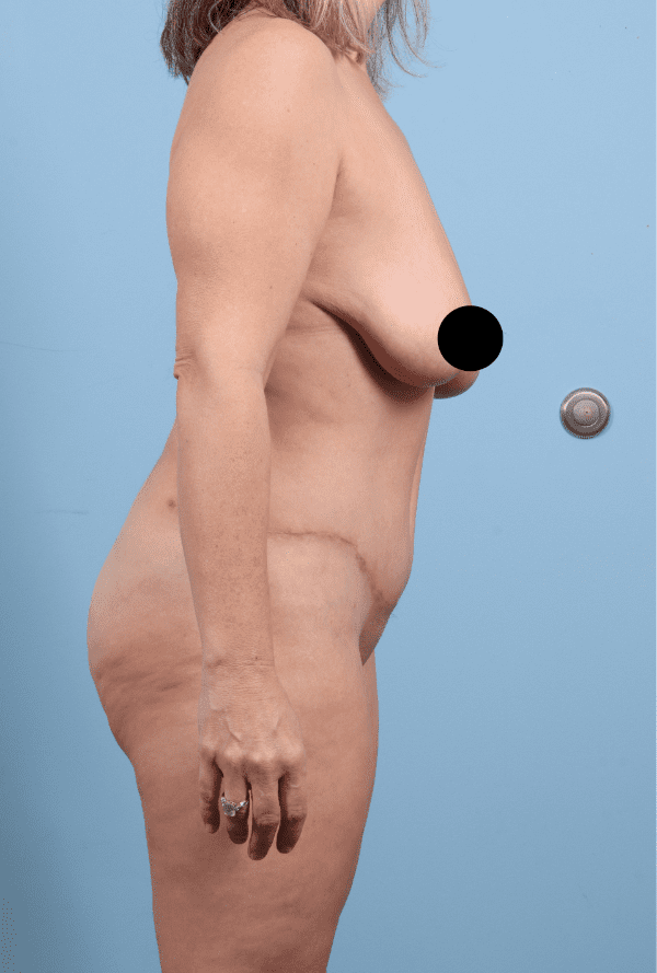 Abdominoplasty Patient Photo - Case 12324 - after view-2