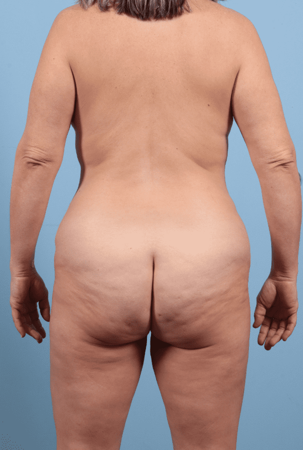 Abdominoplasty Patient Photo - Case 12324 - before view-6