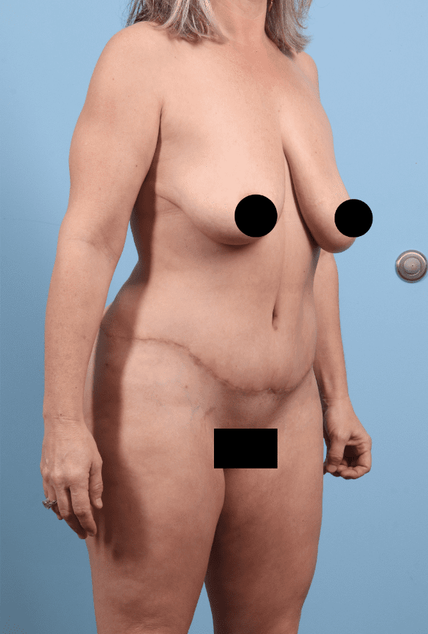 Abdominoplasty Patient Photo - Case 12324 - after view-4