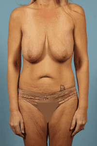 Abdominoplasty - Case 12342 - Before