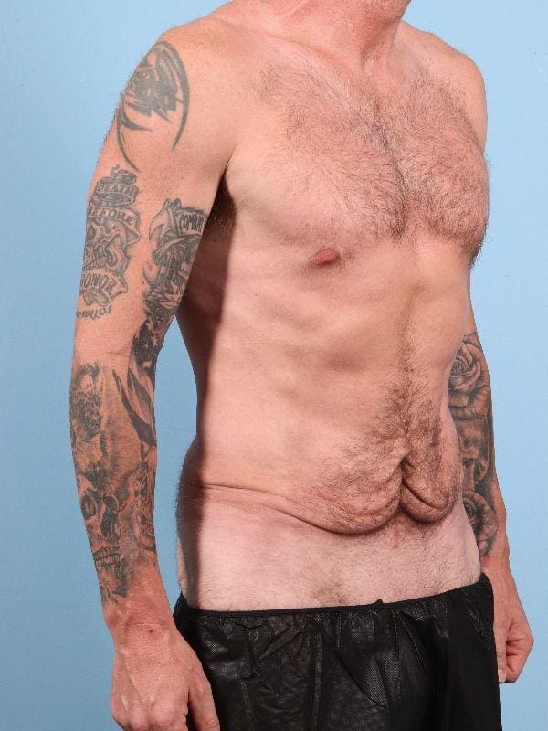 Abdominoplasty Patient Photo - Case 12354 - before view-4