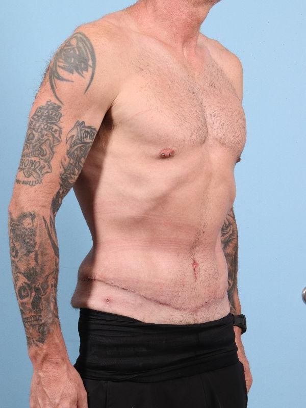 Abdominoplasty Patient Photo - Case 12354 - after view-4