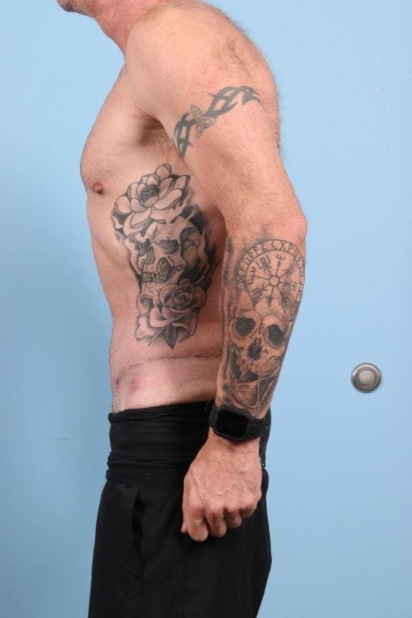 Abdominoplasty Patient Photo - Case 12354 - after view-1