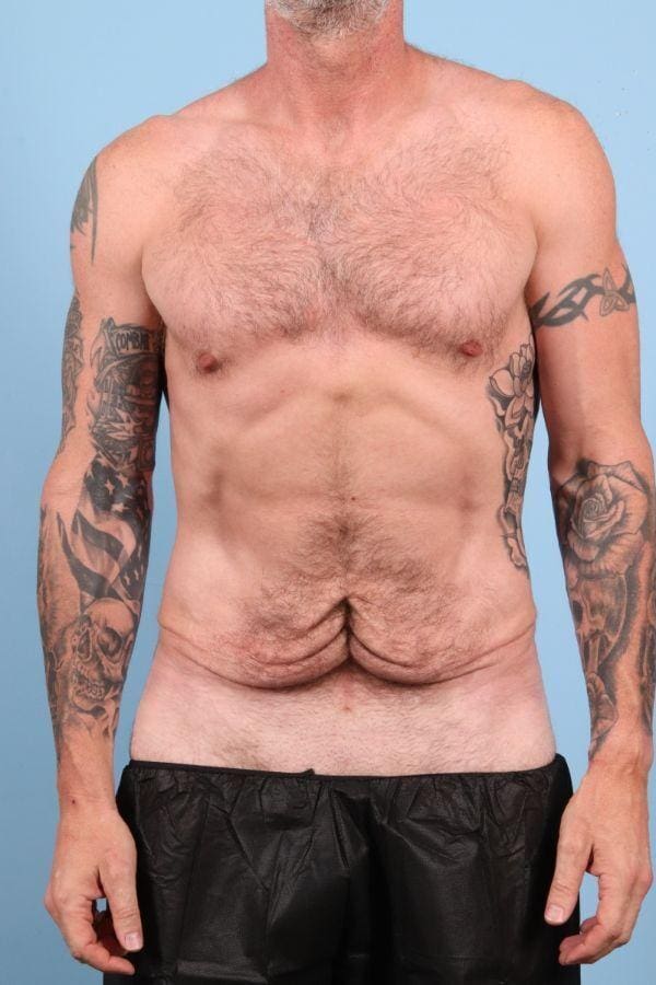 Abdominoplasty Patient Photo - Case 12354 - before view-