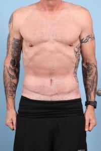 Abdominoplasty - Case 12354 - After