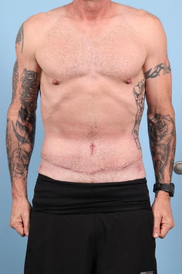 Abdominoplasty Patient Photo - Case 12354 - after view