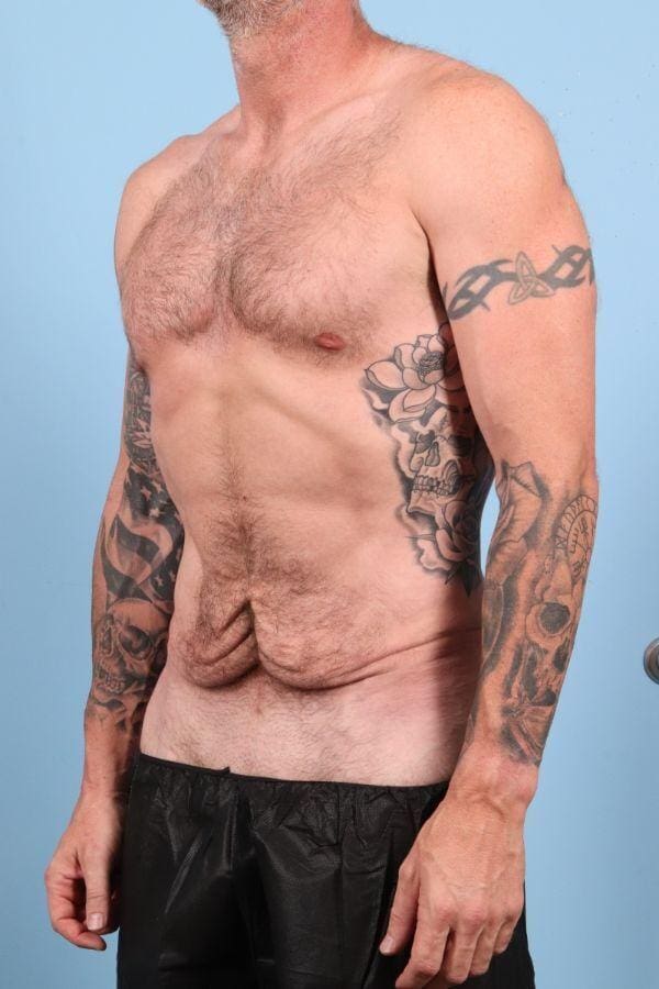 Abdominoplasty Patient Photo - Case 12354 - before view-3