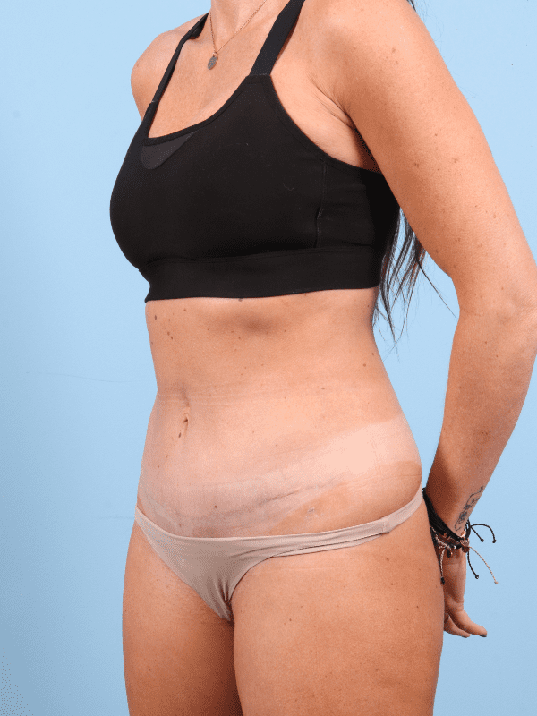 Abdominoplasty Patient Photo - Case 12366 - after view-3