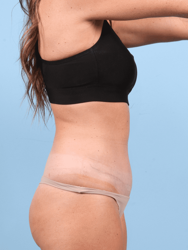 Abdominoplasty Patient Photo - Case 12366 - after view-2