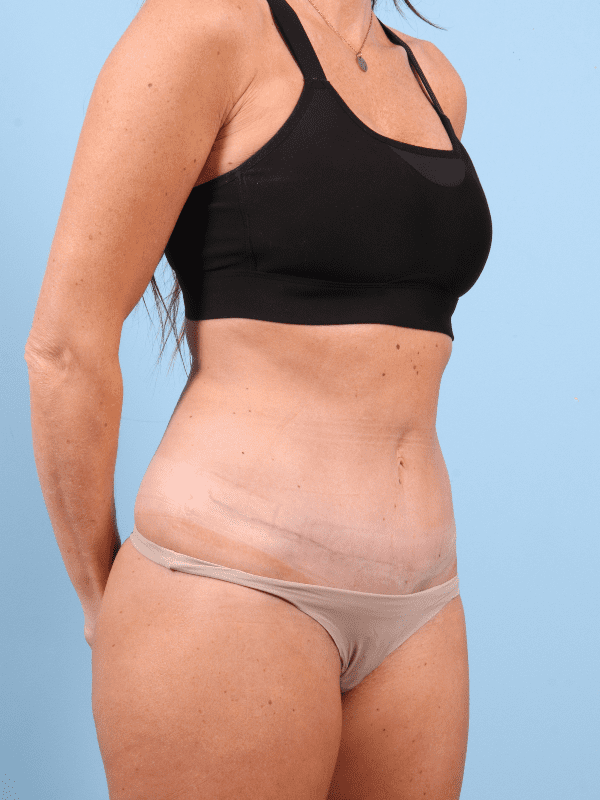 Abdominoplasty Patient Photo - Case 12366 - after view-4