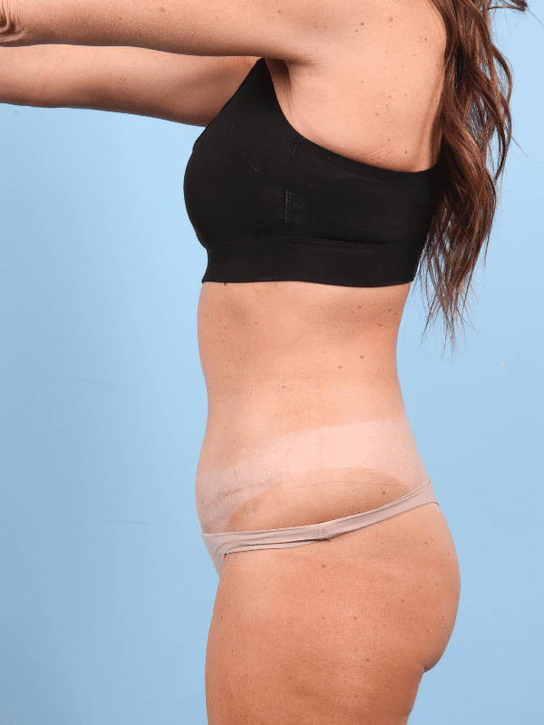 Abdominoplasty Patient Photo - Case 12366 - after view-1