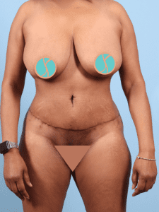 Abdominoplasty - Case 12378 - After