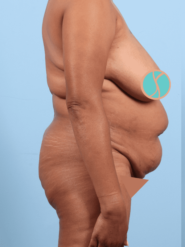 Abdominoplasty Patient Photo - Case 12378 - before view-2